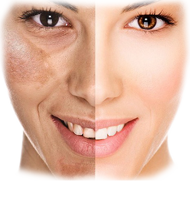 Pigmentation Removal